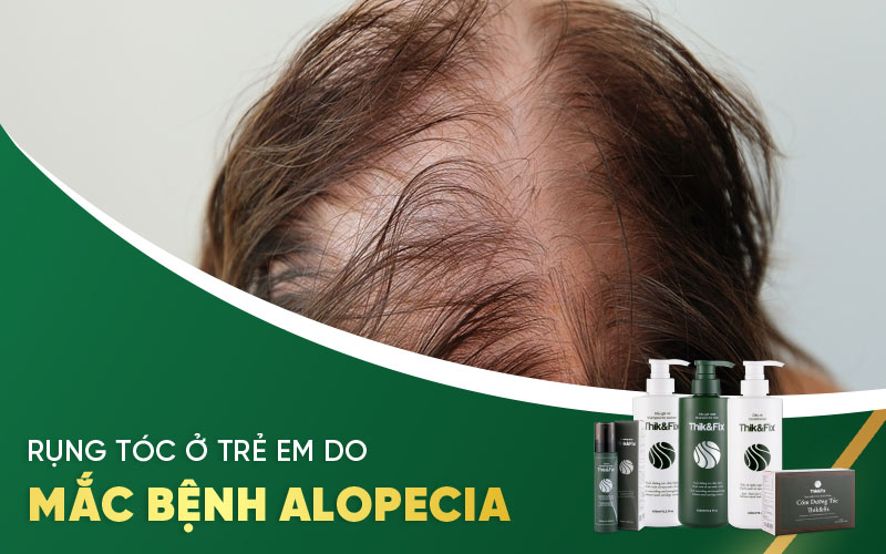 rụng tóc ở trẻ em do mắc bệnh alopecia